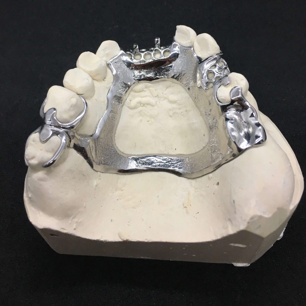 cast partial denture framework on model