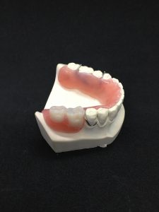 acrylic partial denture on model